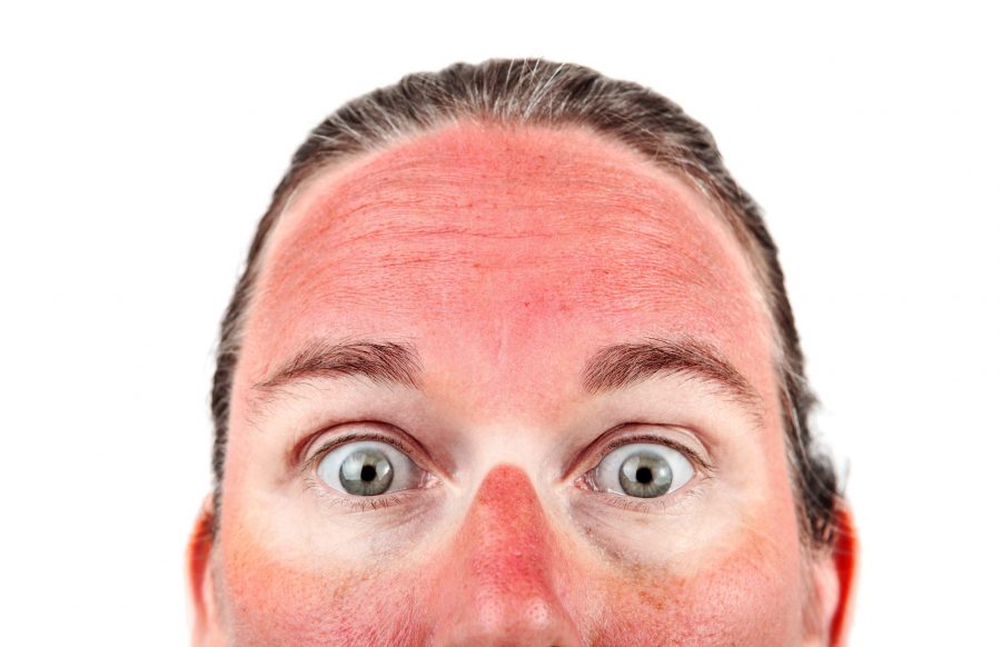 sun-burnt-face